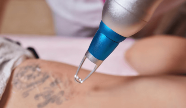 Como quitar un tatuaje
